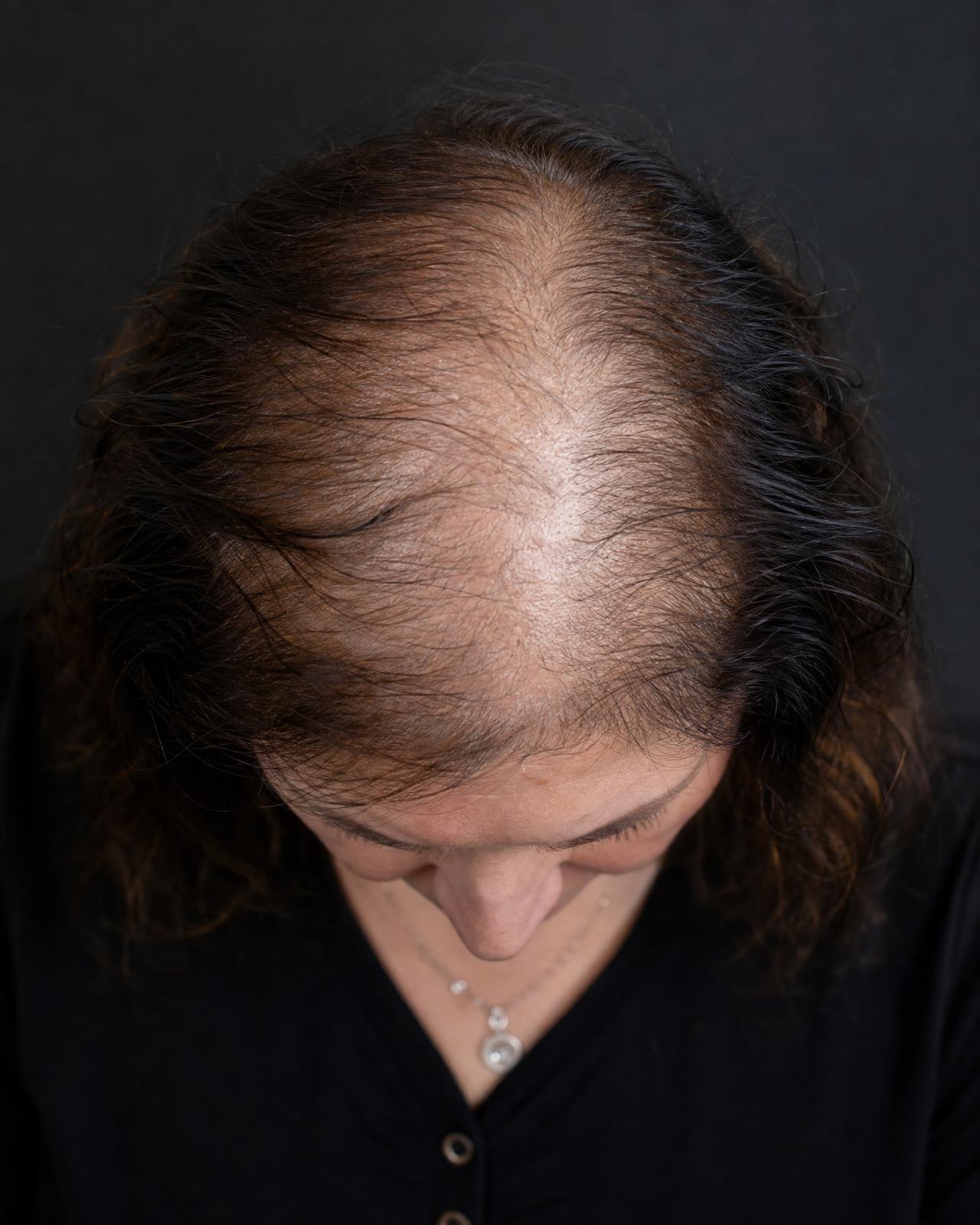 A crown parting showing thinning density on one side and full restored density where an integration has been blended in
